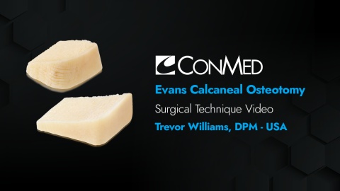Dr. Williams -  Evans Calcaneal Osteotomy