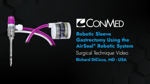 Dr. DiCicco - Robotic Sleeve Gastrectomy Using the AirSeal® Robotic Solution