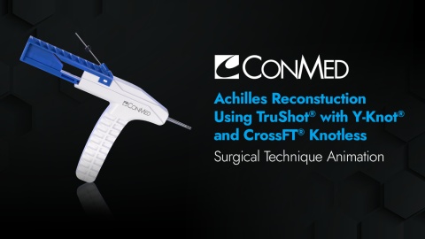 Achilles Reconstruction Using TruShot® with Y-Knot® and CrossFT® Knotless