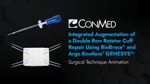 Integrated Augmentation of Double Row Rotator Cuff Repair Using BioBrace® and Argo Knotless® GENESYS™