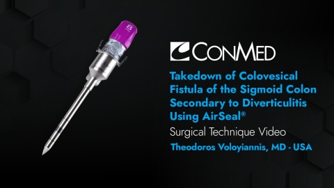 Dr. Voloyiannis - Takedown of Colovesical Fistula of the Sigmoid Colon Secondary to Diverticulitis Using AirSeal®