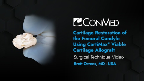 Dr. Owens - Cartilage Restoration of the Femoral Condyle Using CartiMax® Viable Cartilage Allograft