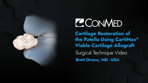 Dr. Owens - Cartilage Restoration of the Patella Using CartiMax® Viable Cartilage Allograft