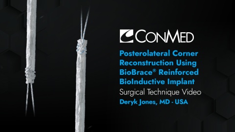 Dr. Jones - Posterolateral Corner Reconstruction Augmented with BioBrace® BioInductive Implant