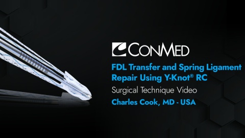FDL Transfer and Spring Ligament Repair Using Y-Knot RC® - Charles Cook, MD