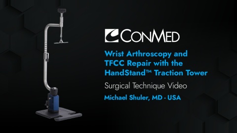 Dr. Shuler - Wrist Arthroscopy and TFCC Repair with the HandStand™ Traction Tower