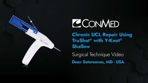 Dr. Sotereanos - Chronic UCL Repair Using TruShot® with Y-Knot® Shallow