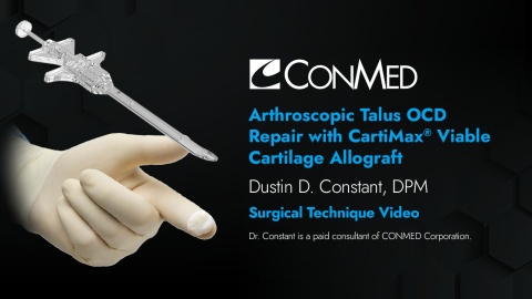 Arthroscopic Talus OCD Repair with CartiMax® Viable Cartilage Allograft - Dustin D. Constant, DPM
