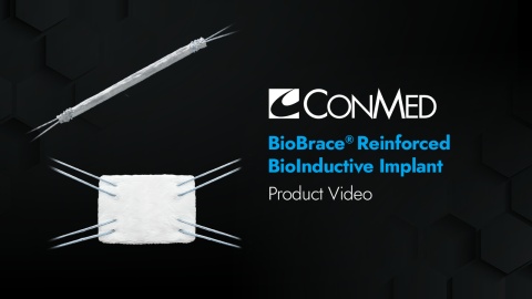 BioBrace® Reinforced Implant - Product Video