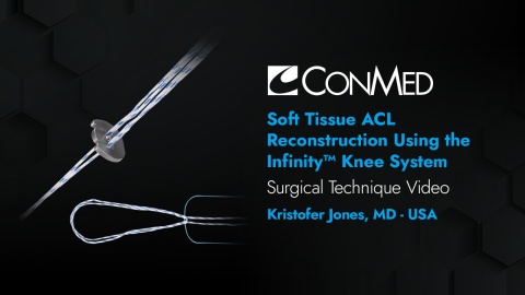 Dr. Jones - Soft Tissue ACL Reconstruction Using the Infinity™ Knee System