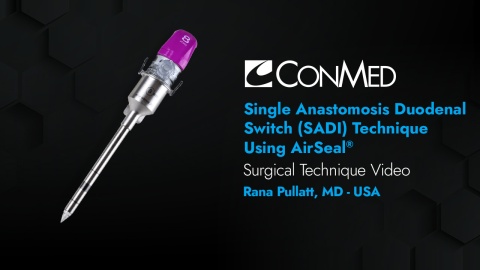 Dr. Pullatt - Single Anastomosis Duodenal Switch (SADI) Technique Using AirSeal®