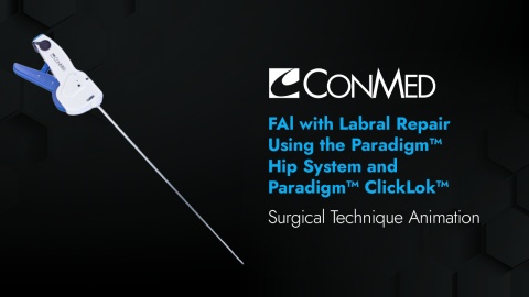 FAI with Labral Repair Using the Paradigm® Hip System and Paradigm® ClickLok™