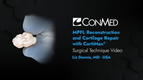 Dr. Dennis - MPFL Reconstruction and Cartilage Repair with CartiMax®