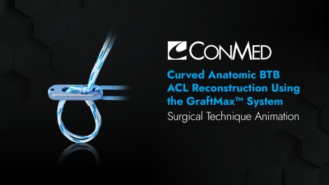Curved Anatomic BTB ACL Reconstruction Using the GraftMax™ System