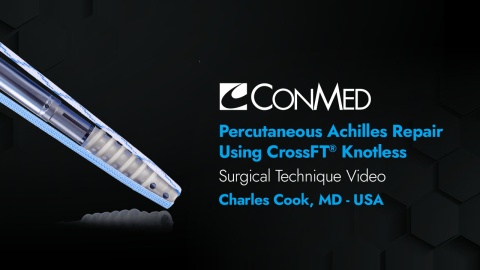 Percutaneous Achilles Repair Using the CrossFT® Knotless - Charles Cook, MD