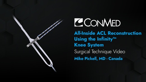 Dr. Pickell - All-Inside ACL Reconstruction Using the Infinity™ Knee System