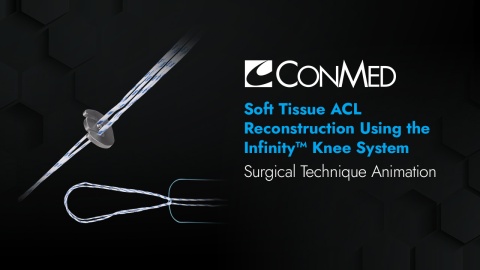 Soft Tissue ACL Reconstruction Using the Infinity™ Knee System