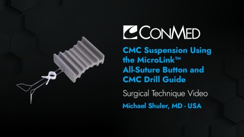 Dr. Shuler - CMC Suspension Using the MicroLink™ All-Suture Button and CMC Drill Guide