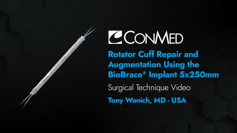 Dr. Wanich - Rotator Cuff Repair and Augmentation Utilizing the BioBrace® Reinforced BioInductive Implant