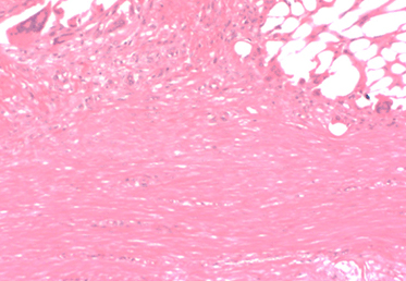 The BioBrace® Implant Filled With New Tissue