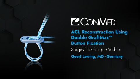 Dr. Lewing - ACL Reconstruction Using Double GraftMax™ Button Fixation