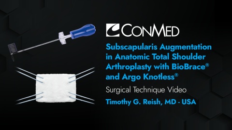 Dr. Reish - Subscapularis Augmentation in Anatomic TSA with BioBrace® and Argo Knotless®