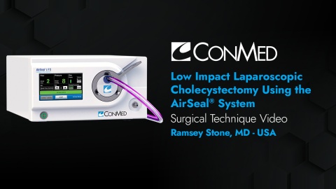Dr. Stone - Laparoscopic Cholecystectomy Using the AirSeal® System