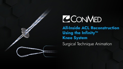 All-Inside ACL Reconstruction Using the Infinity™ Knee System