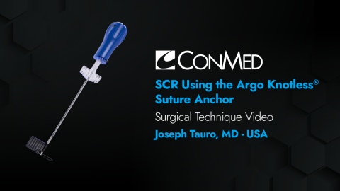 Dr. Tauro -  Superior Capsular Reconstruction (SCR) Using the Argo Knotless® Anchor