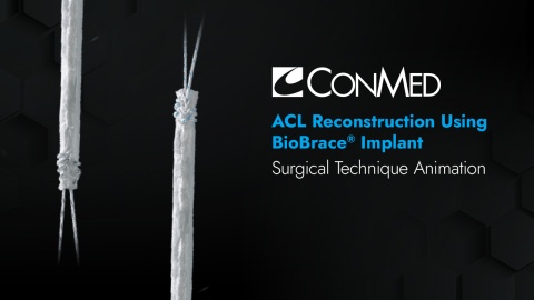 ACL Reconstruction Using BioBrace® Implant