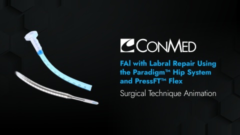 FAI with Labral Repair Using the Paradigm® Hip System and PressFT™ Flex