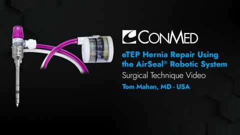 Dr. Mahan - eTEP Hernia Repair Using AirSeal® Robotic Solution