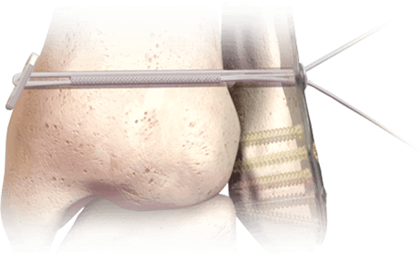 Hercules Knotless Syndesmosis System Diagram