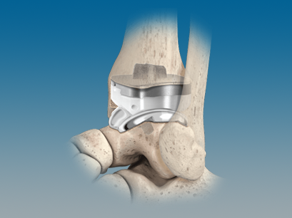 UANTUM Total Ankle System with OrthoPlanify™ PSI