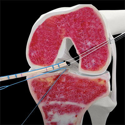 animation of sutures and button being placed in a knee