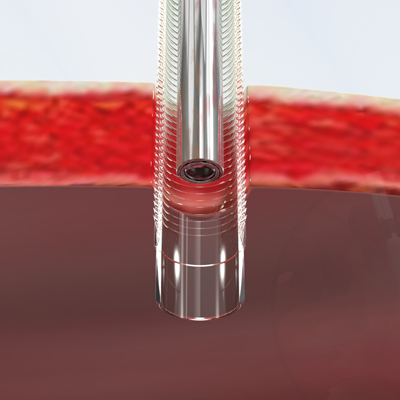 animation of a laparoscopic device being inserted into a body cavity 